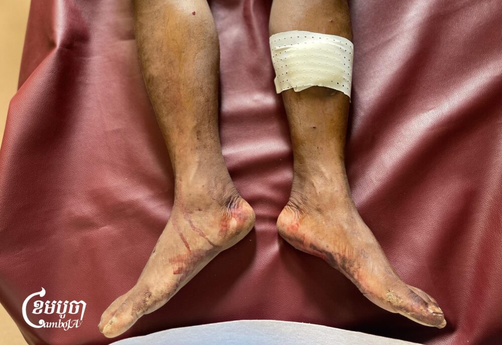 A Cambodian military receives treatment at a hospital in Oddar Meanchey as border clashes continue into July 25, 2025. (CamboJA/Pring Samrang)